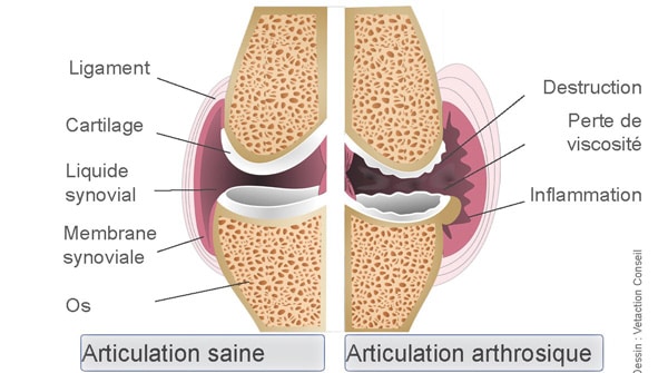 schéma arthrose